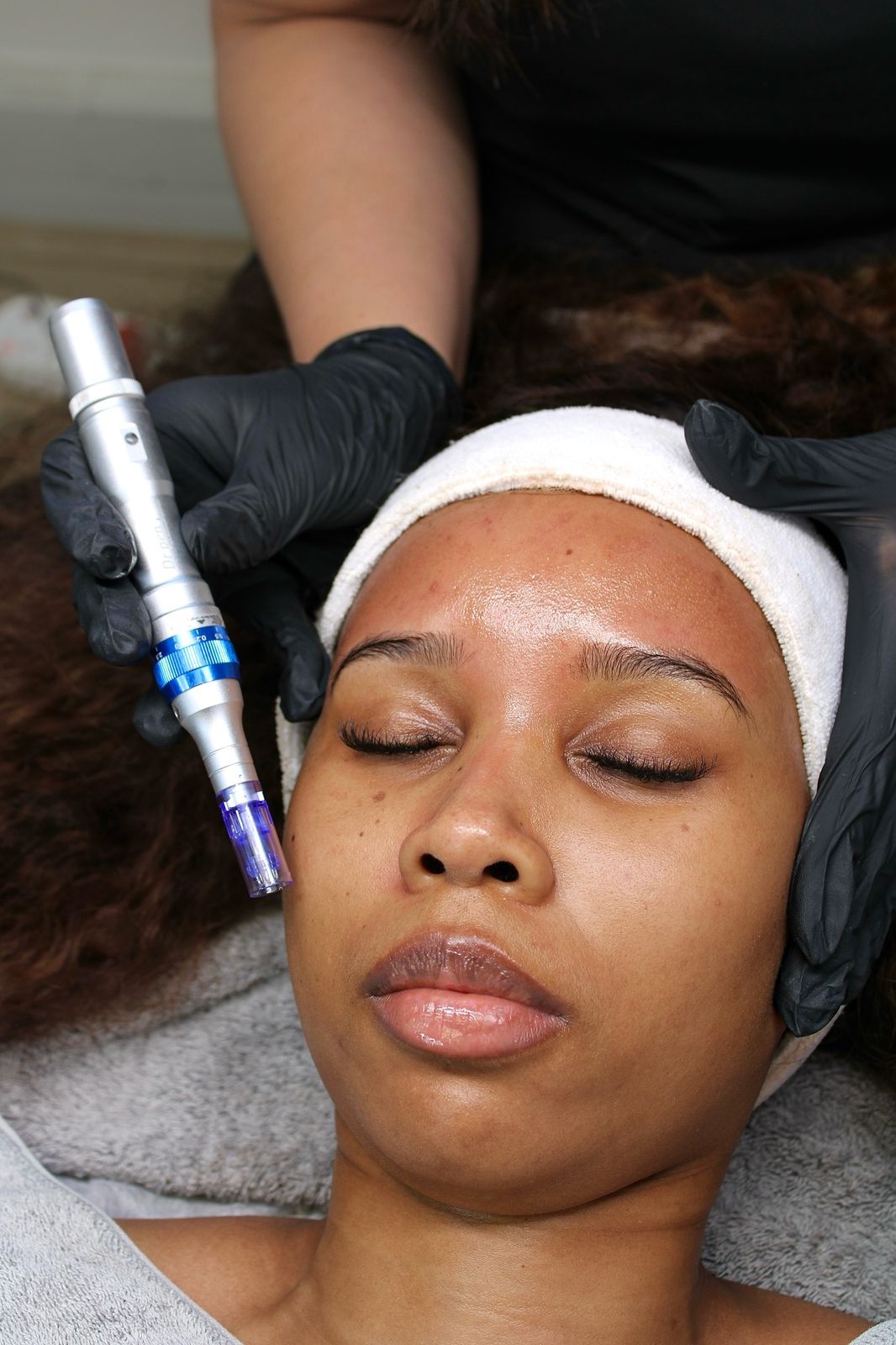 Microneedling
