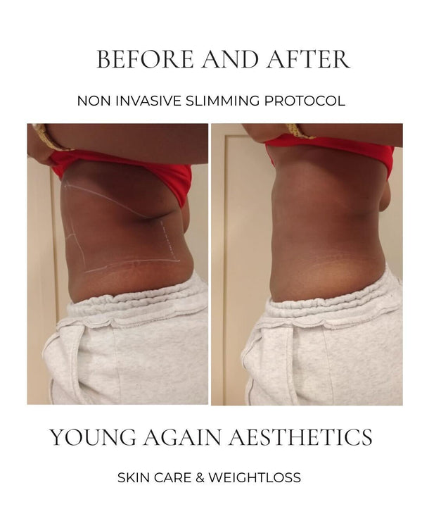 Before and after comparison of a non-invasive slimming protocol by Young Again Aesthetics.