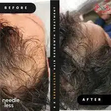 The image shows a before-and-after comparison of hair loss treatment, with the ’after’ side displaying noticeably denser dark brown hair.
