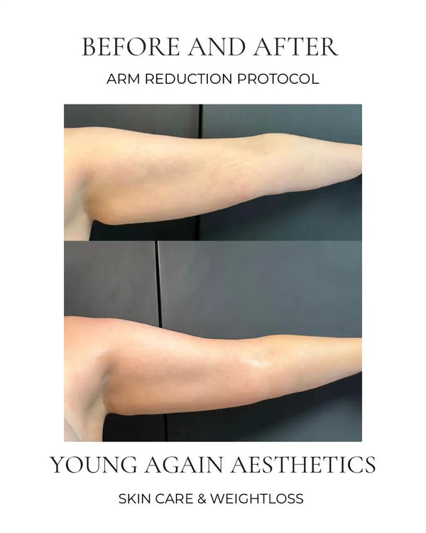 A before-and-after comparison of a person’s arm, showing the difference in skin tone and contour after an arm reduction protocol.