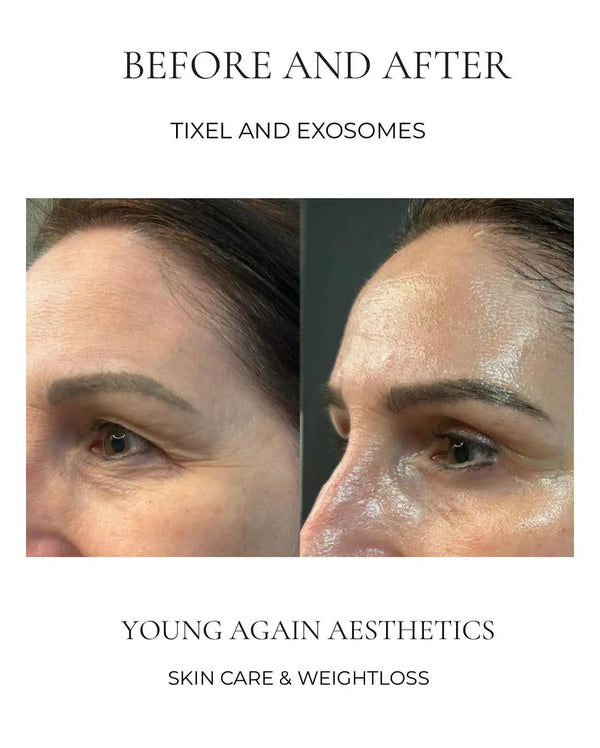 The before-and-after comparison showcases a woman’s face, highlighting the smoother and more radiant skin achieved through tixel and exosomes treatments.