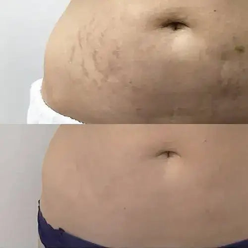 The image shows a before-and-after comparison of skin on the abdomen, with the top half displaying visible stretch marks and the bottom half showing smoother, clearer skin.