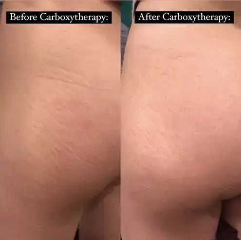 The image shows a before-and-after comparison of skin texture on the buttocks following carboxytherapy, highlighting improved smoothness and reduced visible imperfections.