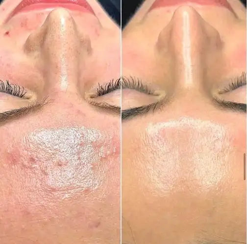 The image shows a before-and-after comparison of skin treatment, with the left side displaying acne and redness on the face and the right side showing smoother, clearer skin.
