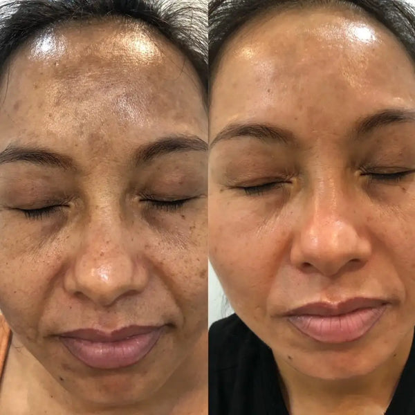 The before-and-after facial skincare results show a woman’s skin transitioning from visibly uneven and freckled to smoother, more radiant with fewer dark spots.