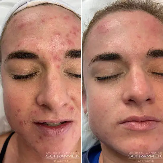 The before-and-after facial treatment results show a noticeable improvement in skin clarity and texture, with the right side displaying smoother, clearer skin compared to the acne-prone left side.