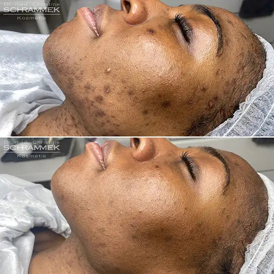 Before-and-after facial treatment results displayed on a woman’s face, showing improved skin texture and reduced acne marks.