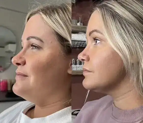 The before-and-after side profile comparison showcases a woman’s nose, highlighting the subtle contouring and refined shape achieved through cosmetic enhancement.