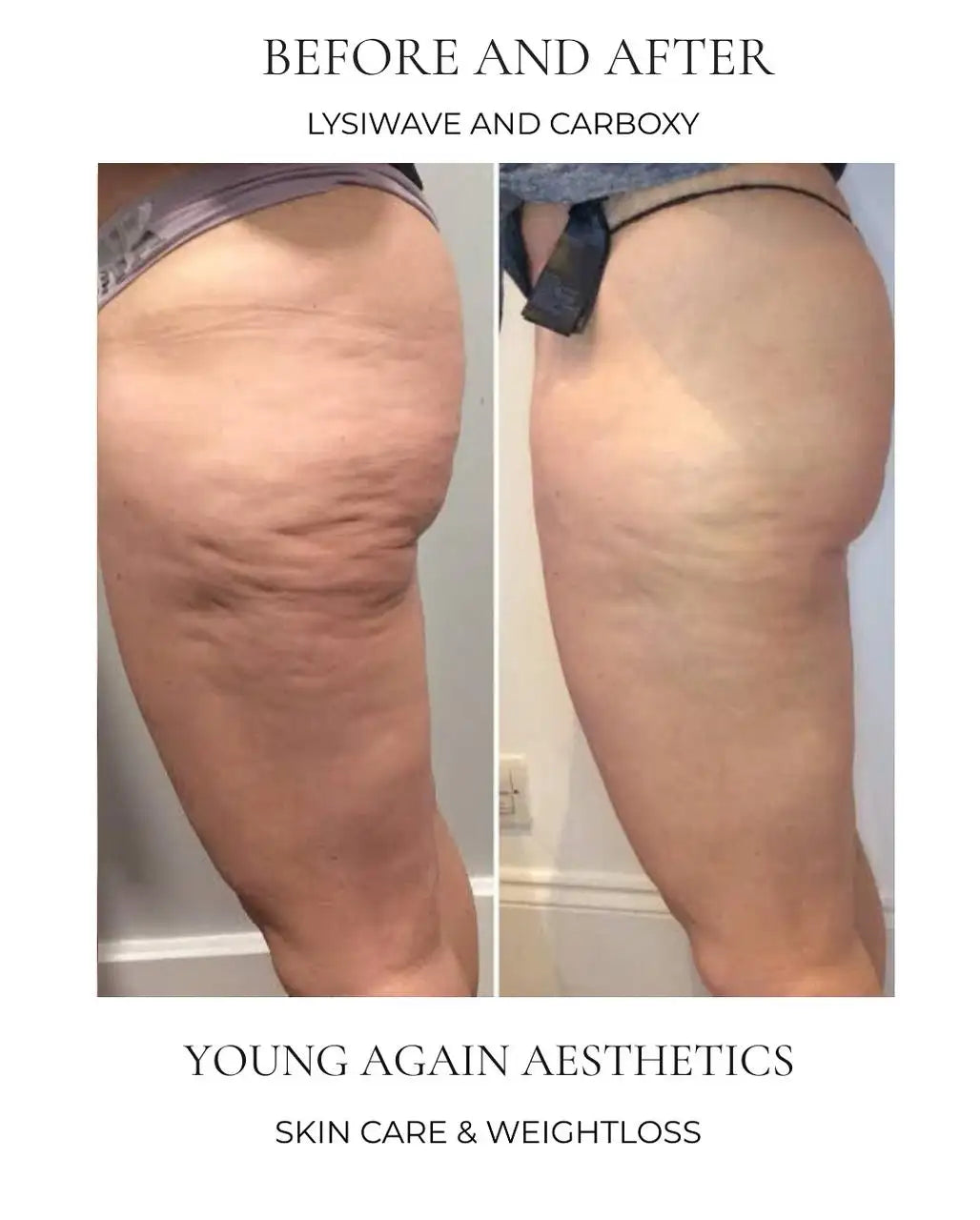The before-and-after image showcases a person’s thigh area, with the left side displaying skin texture and appearance prior to treatment, while the right side shows smoother, more toned skin after undergoing lysiwave and carboxy treatments.