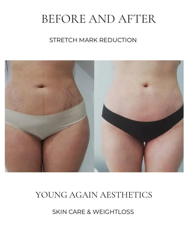 Black and beige stretch mark reduction underwear.