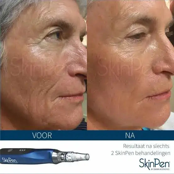 Blue and silver skinpen device with a sleek, ergonomic design for skin treatment.