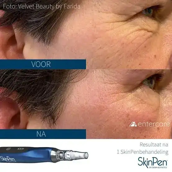 Blue skinpen device with silver metallic accents and a transparent tip.