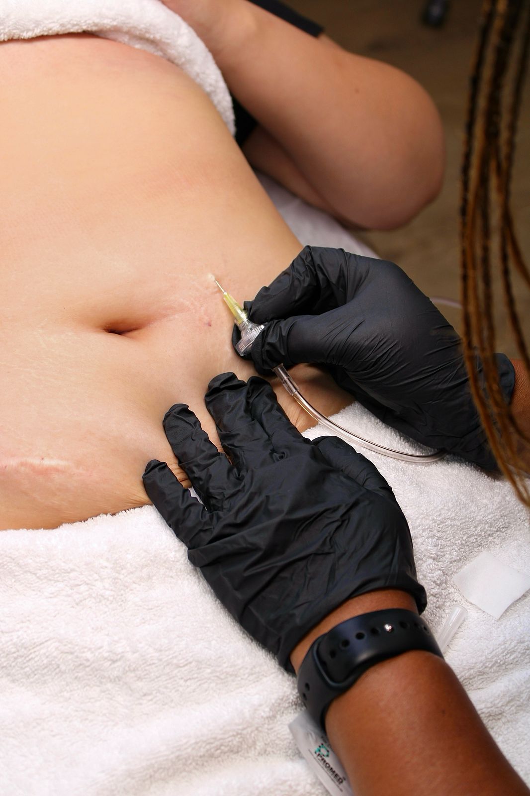 Carboxy Therapy - Treatment