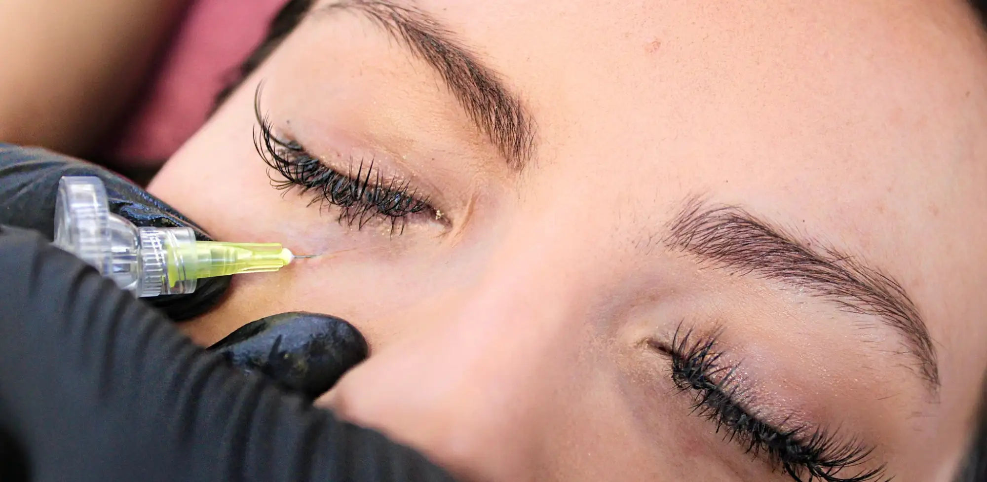 A clear, transparent syringe with a yellow needle tip is being used for an eye treatment.
