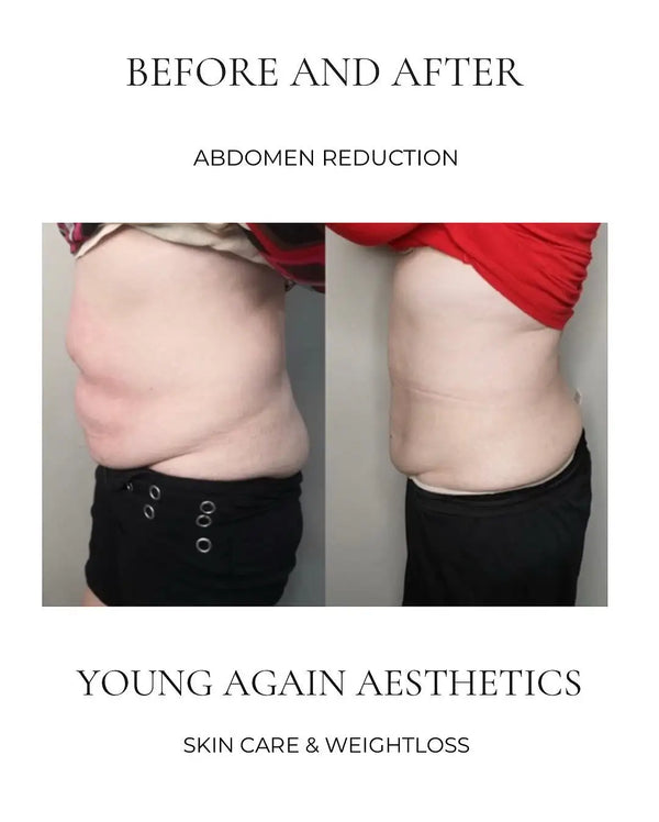 The image displays a before-and-after comparison of an abdomen reduction procedure, showing the person’s midsection in both states.