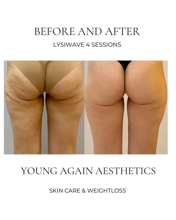 The image displays a before-and-after comparison of buttocks, showing smoother and more toned skin after lysiwave 4 sessions.