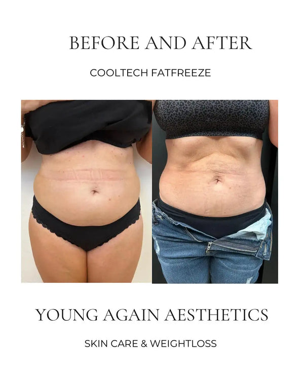The image displays a before-and-after comparison of a person’s midsection following cooltech fatfreeze treatment, showing visible changes in body contour and skin texture.