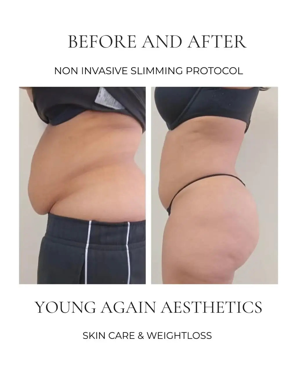 The image displays a before-and-after comparison of a person’s midsection, showing the results of a non-invasive slimming protocol.