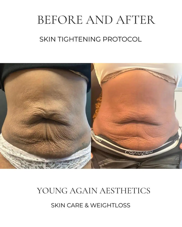 The image displays a before-and-after comparison of skin tightening results, showing the left side as ’before’ with loose, wrinkled skin and the right side as ’after,’ featuring smoother, tighter skin.