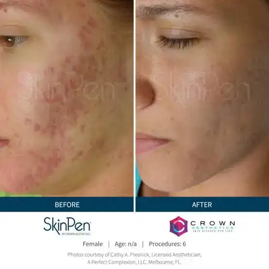 The image displays a before-and-after comparison of skin treatment results, featuring the skinpen device by crown aesthetics.