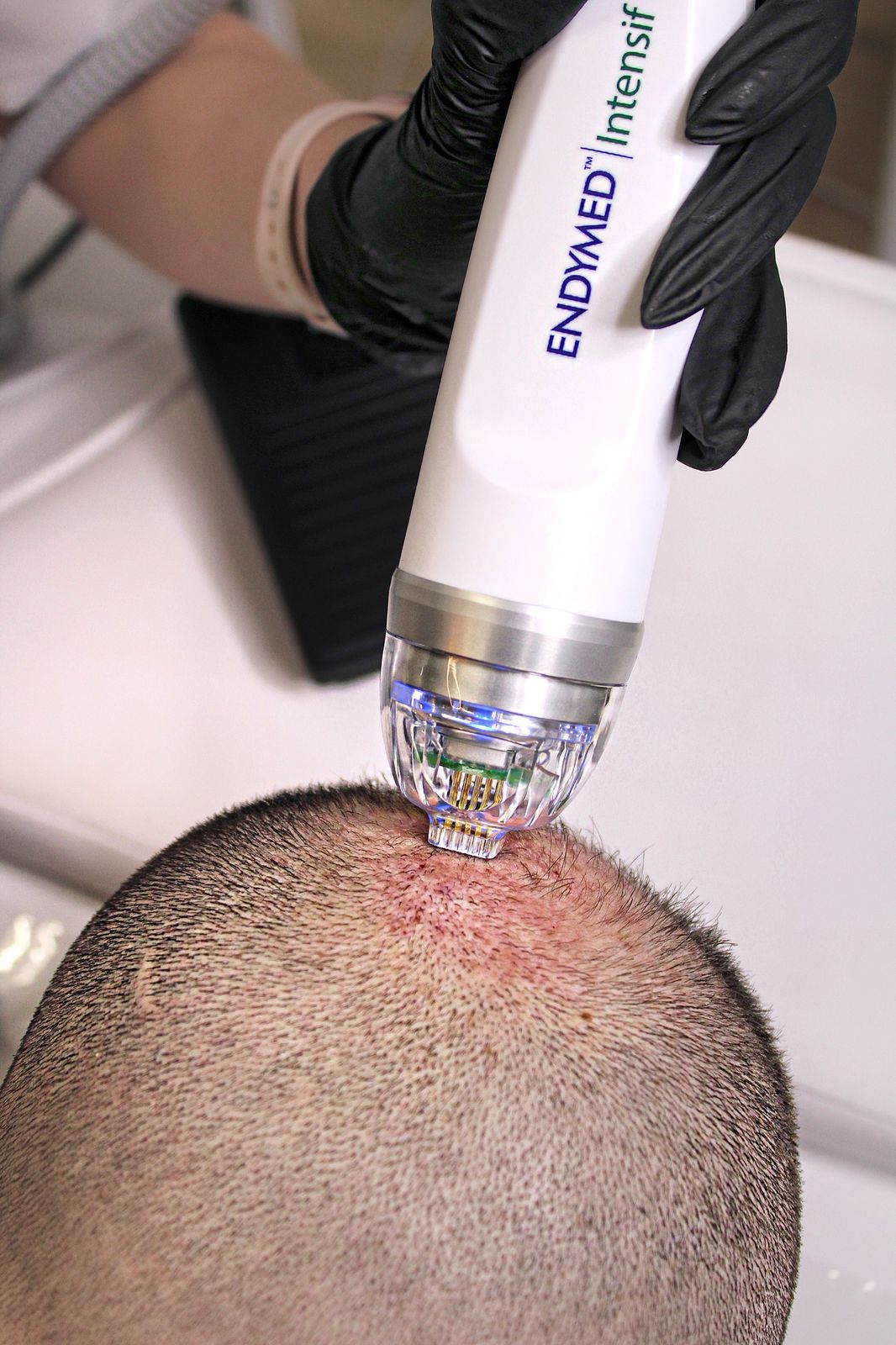 Endymed RF Intensif Microneedling - Treatment