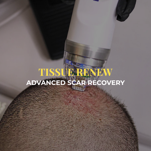 Endymed RF Intensif Microneedling - Treatment