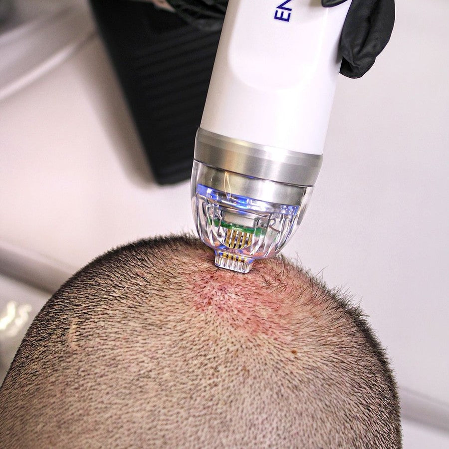 Endymed RF Intensif Microneedling - Treatment