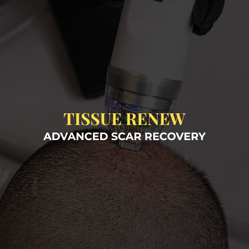 Endymed RF Intensif Microneedling - Treatment