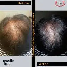The ’before’ and ’after’ images show a hair treatment result, with the right side displaying noticeably lighter, more uniform dark brown or black hair after using the needleless hair regrowth treatment.