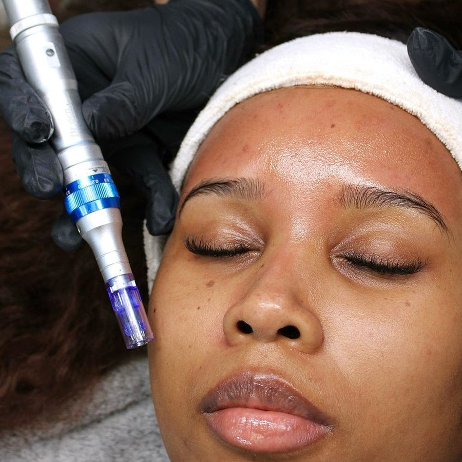 Microneedling - Treatment