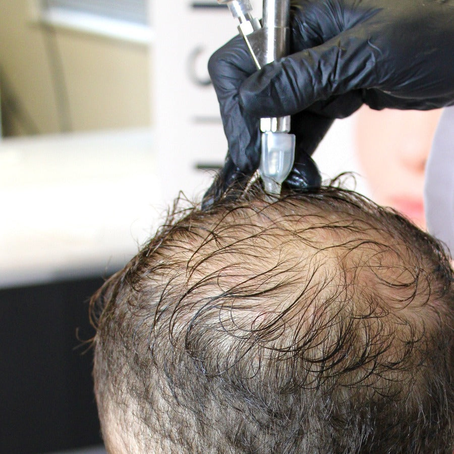 Needleless Hair Restoration - Treatment
