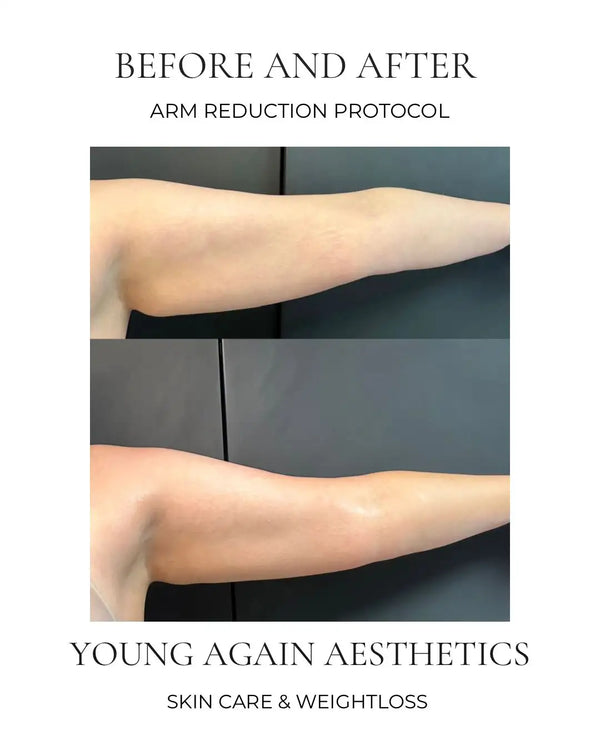 Before image shows a person’s arm with visible fat and skin laxity, while the after image displays a noticeably slimmer, tighter-looking arm.