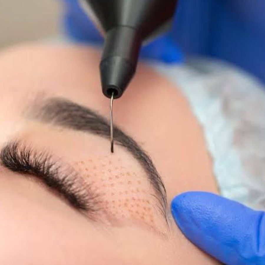 Plasma Pen - Treatment