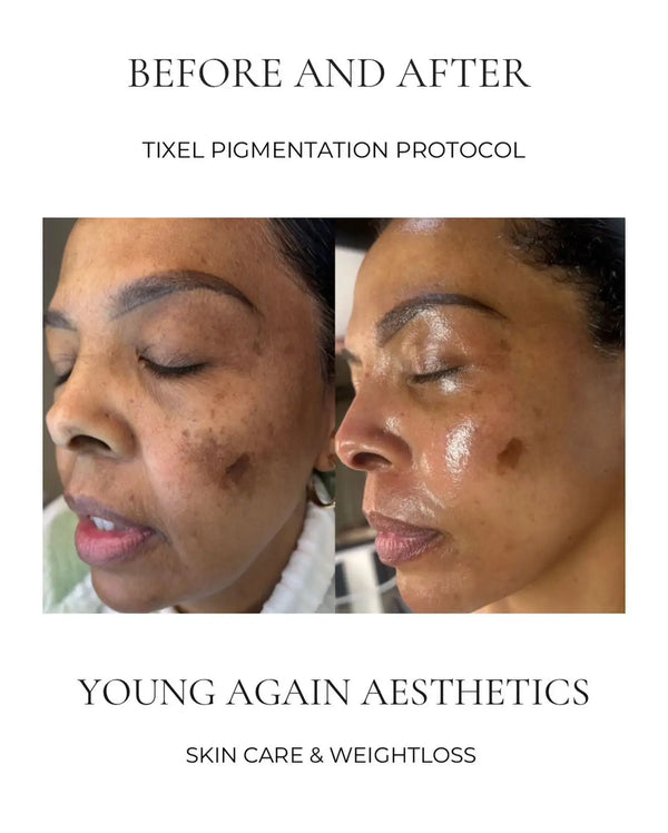 Before and after images showcasing the results of a tixel pigmentation protocol treatment by young again aesthetics.