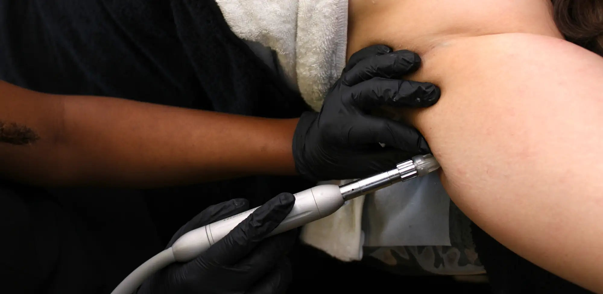 Silver-toned medical device with a cylindrical handle and metallic tip, being used for skin treatment.