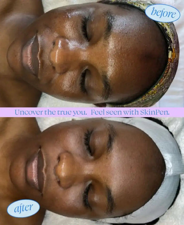 Skinpen device for skin treatment.