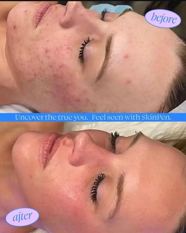 The skinpen device, a sleek metallic handheld tool used for skin resurfacing treatments.