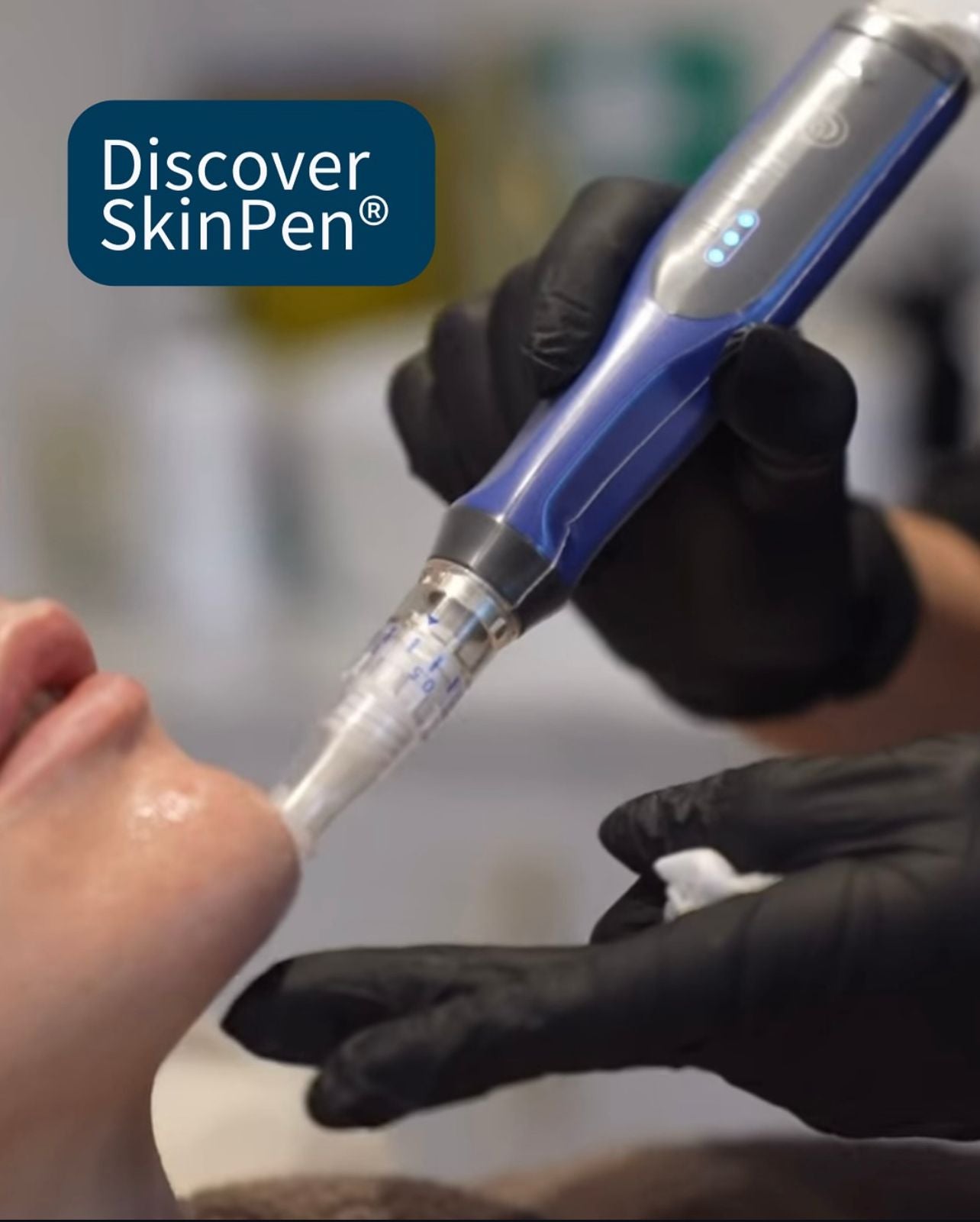 SkinPen Microneedling - Treatment