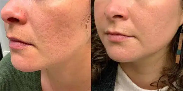 The image shows a split view of a woman’s face before and after skincare treatment, highlighting improved skin texture and clarity.