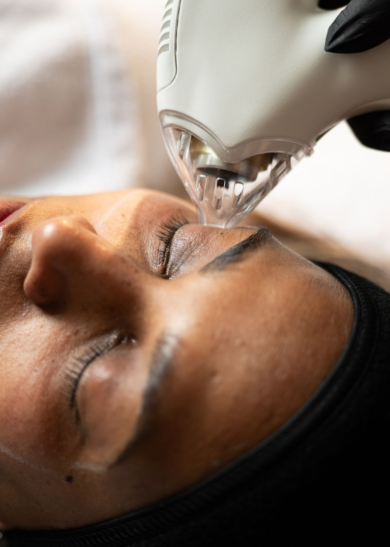 The Tixel-PRX Infusion: The Express Lane to Dermal Transformation - Treatment