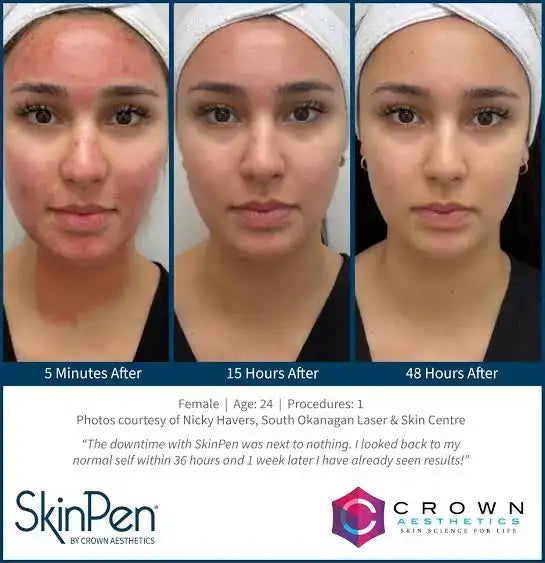 A woman wearing a white headband and black top, with three side-by-side photos showing her face at 5 minutes after treatment, 15 hours after treatment, and 48 hours after treatment.