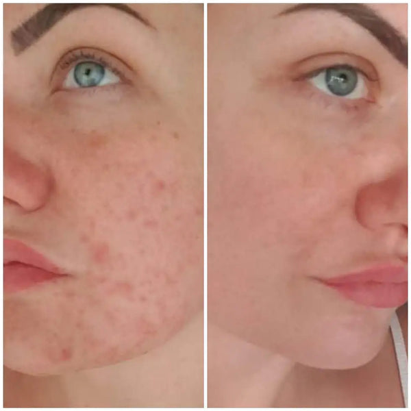 A woman’s face with clear, smooth skin after acne treatment.