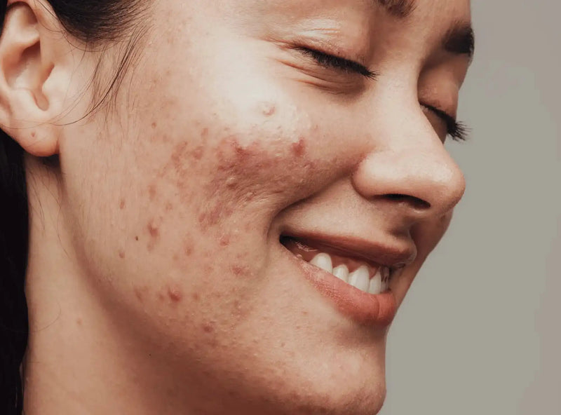 Minimises Acne Scars & Stretch Marks